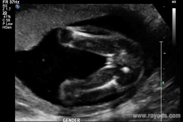 妻双方没有染色体问题，但是我们胎停育7次了， 后一次查了胚染有问题，这种
