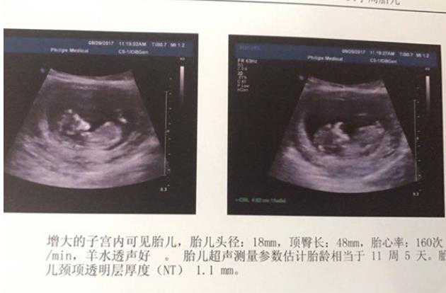 广州借卵代怀好吗 广州哪里能做试管婴儿 ‘三个半月的男女宝彩超图’